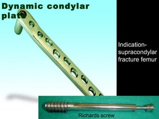 Dynamic condylar
plate
Richards screw
Indication-
supracondylar
fracture femur
 