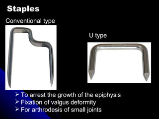 Staples
Conventional type
U type
 To arrest the growth of the epiphysis
 Fixation of valgus deformity
 For arthrodesis of small joints
 