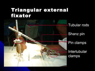 Triangular external
fixator
Tubular rods
Shanz pin
Pin clamps
Intertubular
clamps
 