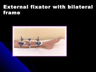 External fixator with bilateral
frame
 