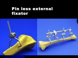 Pin less external
fixator
 