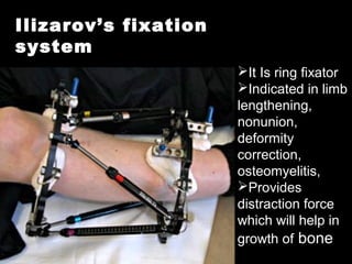 Ilizarov’s fixation
system
It Is ring fixator
Indicated in limb
lengthening,
nonunion,
deformity
correction,
osteomyelitis,
Provides
distraction force
which will help in
growth of bone
 