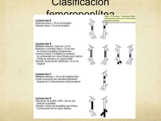 Clasificación
femoropoplítea
 
