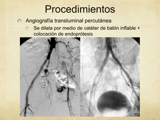 Procedimientos
Angiografía transluminal percutánea
   Se dilata por medio de catéter de balón inflable +
   colocación de endoprótesis
   Limitada para vasos tibiales
 