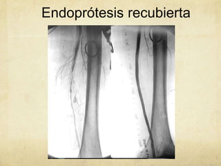 Endoprótesis recubierta
 