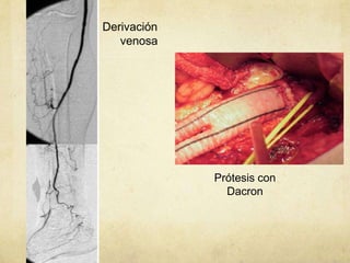 Derivación
   venosa




             Prótesis con
               Dacron
 