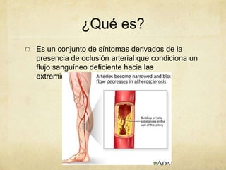 ¿Qué es?
Es un conjunto de síntomas derivados de la
presencia de oclusión arterial que condiciona un
flujo sanguíneo deficiente hacia las
extremidades.
 