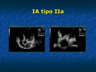IA tipo IIa 