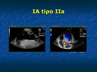 IA tipo IIa 