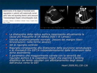 La dilatazione della radice aortica rappresenta attualmente la  causa più frequente  di IA isolata (tipo I di Lansac) Valvola  anatomicamente normale   (lesioni dei margini liberi- fenestrazioni - nelle forme severe) Jet di rigurgito  centrale Rigurgito conseguente alla dilatazione della giunzione senotubulare e al  mismatch tra GST/A  indipendentemente dalle dimensioni della aorta ascendente Il parametro che maggiormente correla con la severità del rigurgito aortico è la  coaptation height  che esprime il tenting diastolico dei lembi valvolari con allontanamento degli stessi dall’anulus verso la GST Heart 2009;95;130-136 