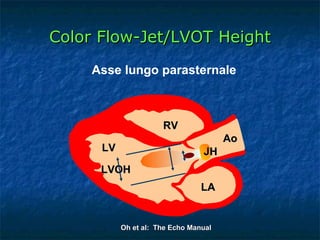 Color Flow-Jet/LVOT Height Asse lungo parasternale LA LV RV LVOH Ao JH Oh et al:  The Echo Manual 