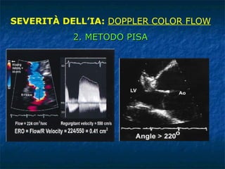 SEVERITÀ DELL’IA:  DOPPLER COLOR FLOW 2. METODO PISA 