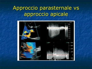 Approccio parasternale vs approccio apicale 