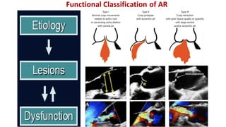 Comprehensive Insights into Aortic Insufficiency: Diagnosis ...