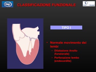 TIPO ITIPO I
• Normale movimento dei
lembi
– Dilatazione Anello
(funzionale)
– Perforazione lembo
(endocardite)
CLASSIFICA...