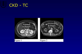 CKD - TC
 