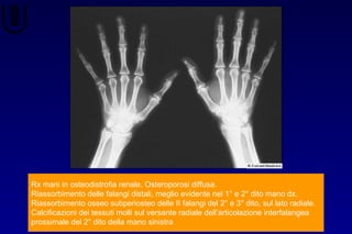 Rx mani in osteodistrofia renale. Osteroporosi diffusa.
Riassorbimento delle falangi distali, meglio evidente nel 1° e 2° dito mano dx.
Riassorbimento osseo subperiosteo delle II falangi del 2° e 3° dito, sul lato radiale.
Calcificazioni dei tessuti molli sul versante radiale dell’articolazione interfalangea
prossimale del 2° dito della mano sinistra
 