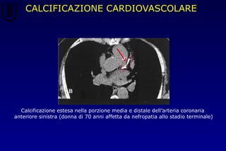 CALCIFICAZIONE CARDIOVASCOLARE
Calcificazione estesa nella porzione media e distale dell’arteria coronaria
anteriore sinistra (donna di 70 anni affetta da nefropatia allo stadio terminale)
 