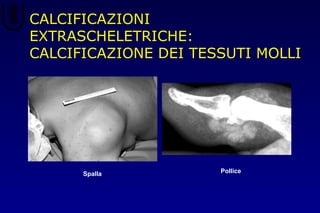 CALCIFICAZIONI
EXTRASCHELETRICHE:
CALCIFICAZIONE DEI TESSUTI MOLLI
Spalla Pollice
 