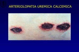 ARTERIOLOPATIA UREMICA CALCEMICA
 