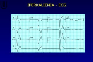ECG: bradicardia, assenza dell’onda P in D II, slargamento del QRS in tutte le
derivazioni, onde T aguzze nelle derivazioni inferiori e precordiali
IPERKALIEMIA - ECG
 