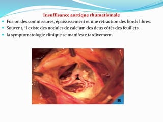 Insuffisance aortique rhumatismale
 Fusion des commissures, épaississement et une rétraction des bords libres.
 Souvent, il existe des nodules de calcium des deux côtés des feuillets.
 la symptomatologie clinique se manifeste tardivement.
 