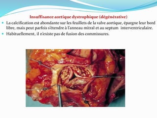 Insuffisance aortique dystrophique (dégénérative)
 La calcification est abondante sur les feuillets de la valve aortique, épargne leur bord
libre, mais peut parfois s’étendre à l’anneau mitral et au septum interventriculaire.
 Habituellement, il n’existe pas de fusion des commissures.
 