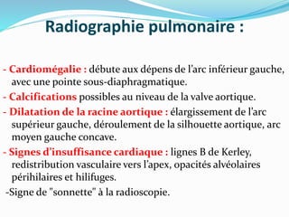 Radiographie pulmonaire :
- Cardiomégalie : débute aux dépens de l’arc inférieur gauche,
avec une pointe sous-diaphragmatique.
- Calcifications possibles au niveau de la valve aortique.
- Dilatation de la racine aortique : élargissement de l’arc
supérieur gauche, déroulement de la silhouette aortique, arc
moyen gauche concave.
- Signes d’insuffisance cardiaque : lignes B de Kerley,
redistribution vasculaire vers l’apex, opacités alvéolaires
périhilaires et hilifuges.
-Signe de "sonnette" à la radioscopie.
 