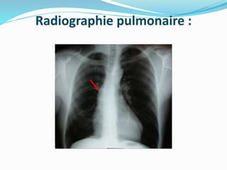 Radiographie pulmonaire :
 