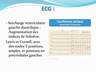 ECG :
- Surcharge ventriculaire
gauche diastolique :
Augmentation des
indices de Sokolow,
Lewis et Cornell, avec
des ondes T positives,
amples, et pointues en
précordiales gauches
 