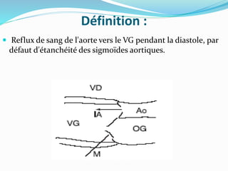 Définition :
 Reflux de sang de l'aorte vers le VG pendant la diastole, par
défaut d'étanchéité des sigmoïdes aortiques.
 
