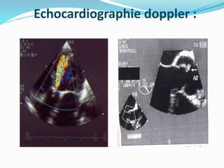 Echocardiographie doppler :
 