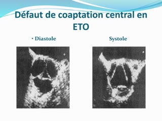 Défaut de coaptation central en
ETO
• Diastole Systole
 
