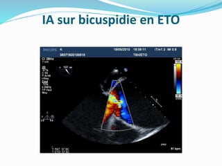 IA sur bicuspidie en ETO
 