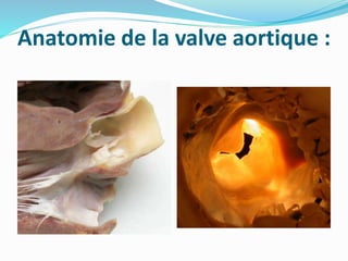 Anatomie de la valve aortique :
 