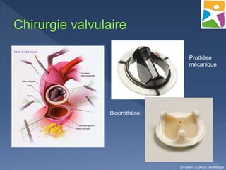 Dr Gabin LEGROS cardiologue
Prothèse
mécanique
Bioprothèse
 