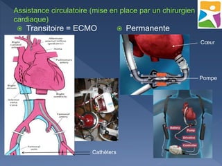  Transitoire = ECMO  Permanente
Cathéters
Cœur
Pompe
 