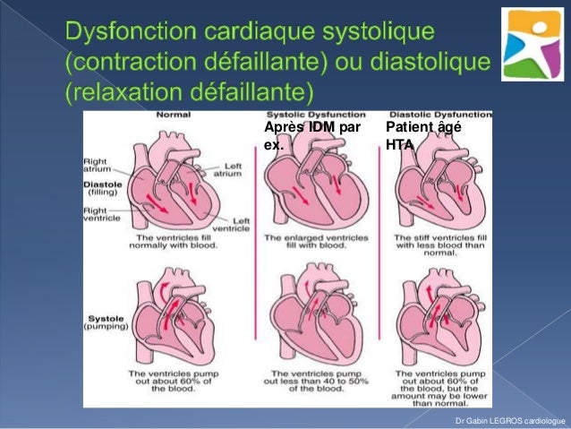 Insuffisance cardiaque