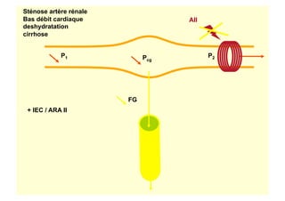 Pcg
FG
P1 P2
Sténose artère rénale
Bas débit cardiaque
deshydratation
cirrhose
AII
+ IEC / ARA II
 