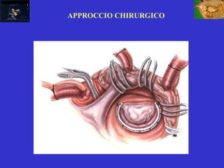 APPROCCIO CHIRURGICO
 