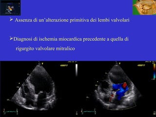  Assenza di un’alterazione primitiva dei lembi valvolari
Diagnosi di ischemia miocardica precedente a quella di
rigurgito valvolare mitralico
 