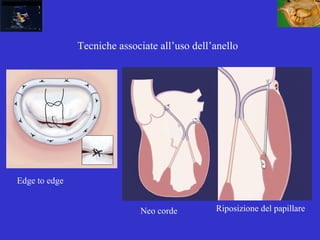 Tecniche associate all’uso dell’anello
Neo corde Riposizione del papillare
Edge to edge
 
