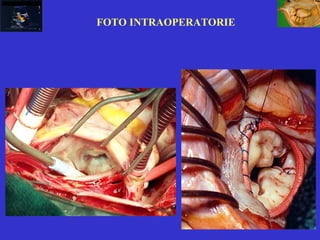 FOTO INTRAOPERATORIE
 