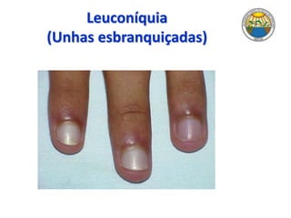 Leuconíquia
(Unhas esbranquiçadas)
 