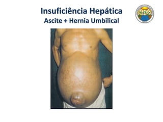 Insuficiência Hepática
Ascite + Hernia Umbilical
 