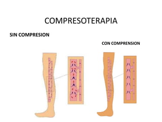 COMPRESOTERAPIA
SIN COMPRESION
CON COMPRENSION
 