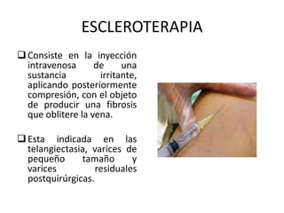 ESCLEROTERAPIA
Consiste en la inyección
intravenosa de una
sustancia irritante,
aplicando posteriormente
compresión, con el objeto
de producir una fibrosis
que oblitere la vena.
Esta indicada en las
telangiectasia, varices de
pequeño tamaño y
varices residuales
postquirúrgicas.
 