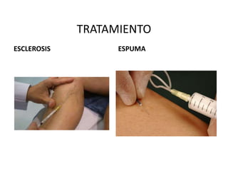 TRATAMIENTO
ESCLEROSIS ESPUMA
 