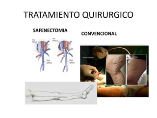 TRATAMIENTO QUIRURGICO
SAFENECTOMIA
CONVENCIONAL
 