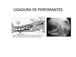 LIGADURA DE PERFORANTES
 